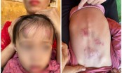 SỐC: Bé gái 2 tuổi bị bạn học đánh đập dã man trong trường mầm non