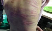 Bé gái 9 tuổi ở TP.HCM bị “chị dâu” bạo hành, thương tích đầy người