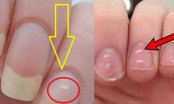 Những đốm trắng trên móng tay có phải là “dấu hiệu của bệnh”? Không quá muộn để biết những sự thật này