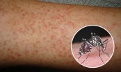 Loại thuốc người bệnh sốt xuất huyết nên tránh dùng