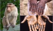 TP.HCM ghi nhận ca bệnh đậu mùa khỉ đầu tiên
