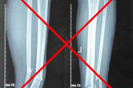 Sự thật về ảnh chụp X-quang gãy chân của Hùng Dũng gây xôn xao mạng xã hội
