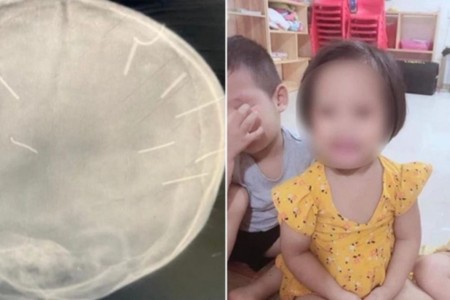 Bé gái 3 tuổi bị đóng đinh vào đầu: Bị đâm tới 10 cái đinh chứ không phải 9