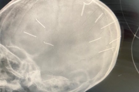 SỐC: Bé gái 3 tuổi ở Thạch Thất bị cắm 9 chiếc đinh vào đầu