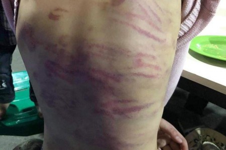 Bé gái 9 tuổi ở TP.HCM bị “chị dâu” bạo hành, thương tích đầy người