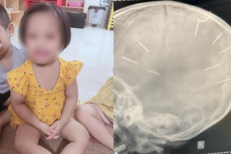 Netizen Hàn Quốc phẫn nộ về vụ 'bé gái 3 tuổi bị đóng 9 cây đinh vào đầu'