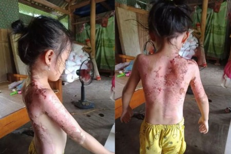 Phú Thọ: Mâu thuẫn, người phụ nữ dội nước sôi vào 4 mẹ con hàng xóm