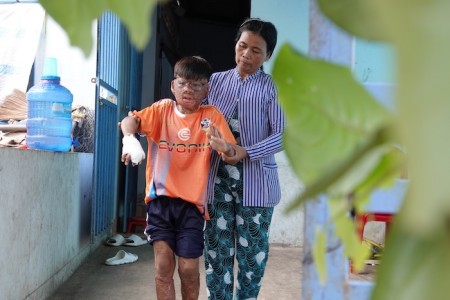 Vu lan tháng 7 năm đó: Cậu bé miền Tây lao vào nguy hiểm cứu mẹ nuôi, bị bỏng 96% cơ thể