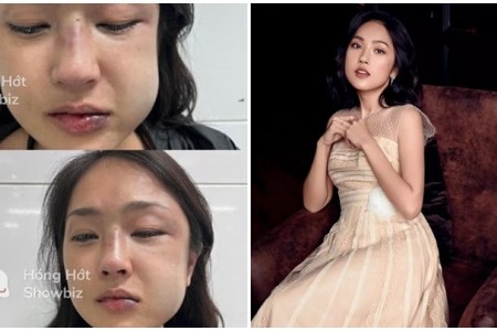 MC Misoa Kim Anh bị đánh sưng mặt vì phát hiện bạn trai lăng nhăng
