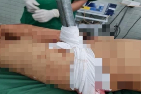 Tai nạn kinh hoàng: Nam thanh niên bị thanh sắt xuyên từ bẹn đùi ra sau mông, treo người trên thành cầu