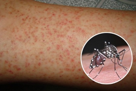 Loại thuốc người bệnh sốt xuất huyết nên tránh dùng