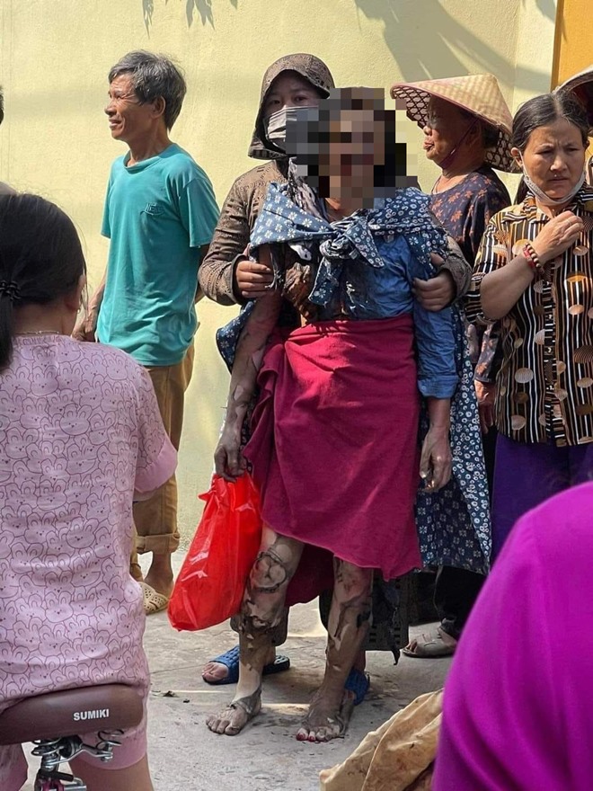 Vụ 3 con gái đốt nhà mẹ ở Hưng Yên: Người mẹ đã 2 lần ghép da tự thân, sức khỏe rất yếu